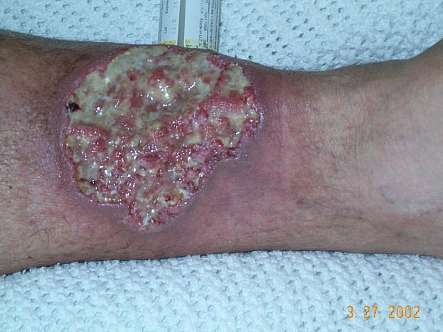 Crohnie_Pyoderma_gangrenosum.jpg